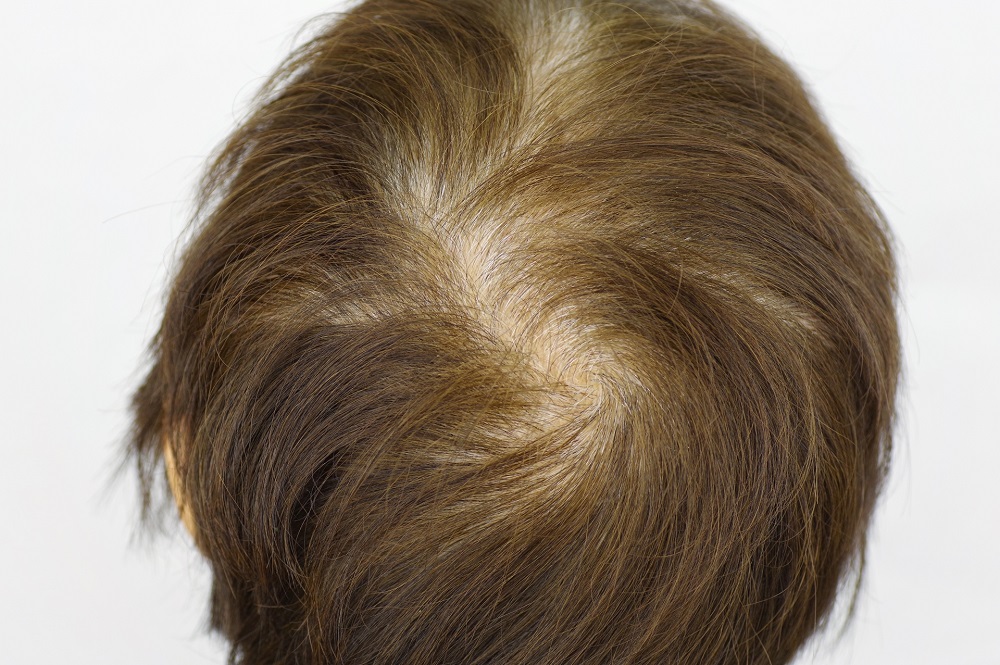 女性の薄毛の症状 びまん性脱毛症 とは 原因や治療法について 医師監修 銀クリaga Com Presented By 銀座総合美容クリニック
