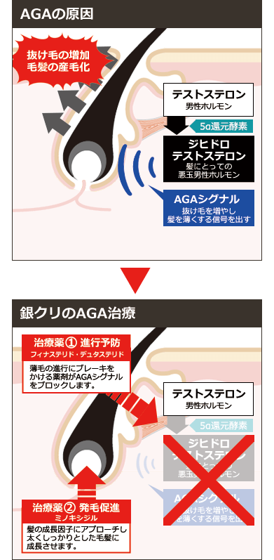 AGAの原因とメカニズムの図解