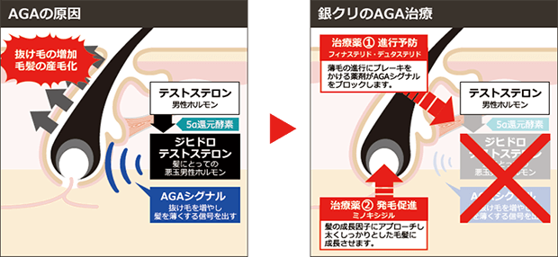 AGAの原因とメカニズムの図解