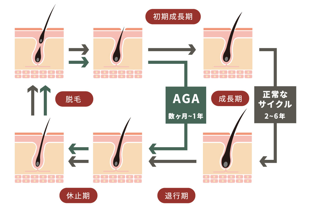 AGAになった場合のヘアサイクル