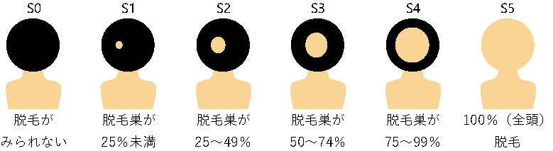 円形脱毛症の重症度具合