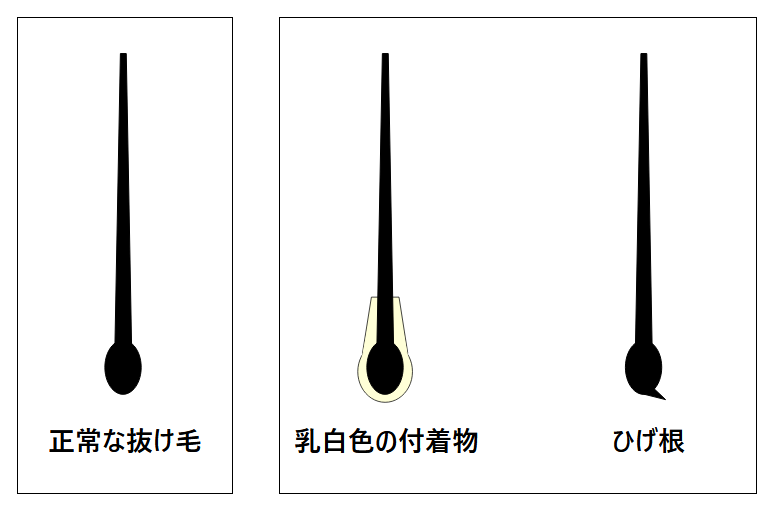 牽引性脱毛症の特徴的な抜け毛の症状